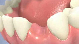 Pose d'un implant dentaire en 2 temps avec un pilier titane